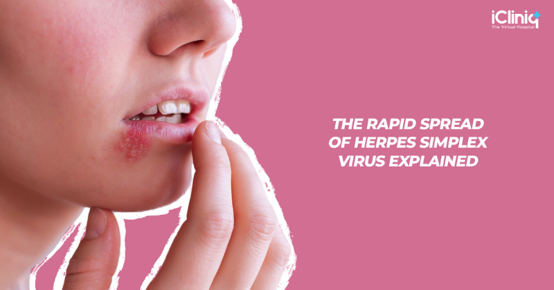 How Does Herpes Simplex Virus Spread So Quickly?